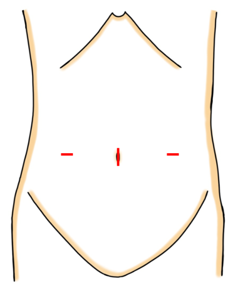 図4.腹腔鏡アプローチ⽪膚切開
